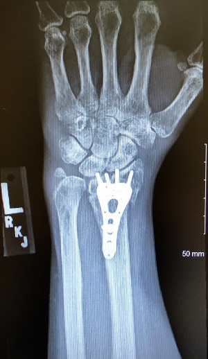 bionic wrist